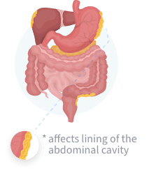 Peritoneal Mesothelioma