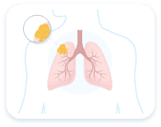 Lungs with Pleural Mesothelioma Stage 2