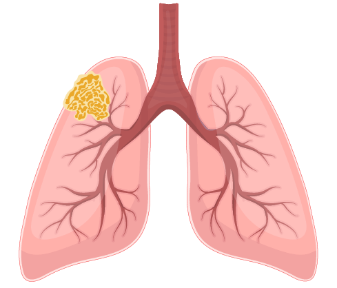 Mesothelioma: What to Know About Malignant Mesothelioma Cancer