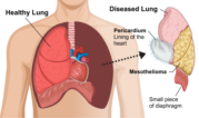 Extrapleural pneumonectomy (EPP)