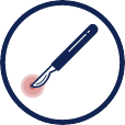 Blue graphic of a scalpel. Illustrates the concept of mesothelioma surgery.