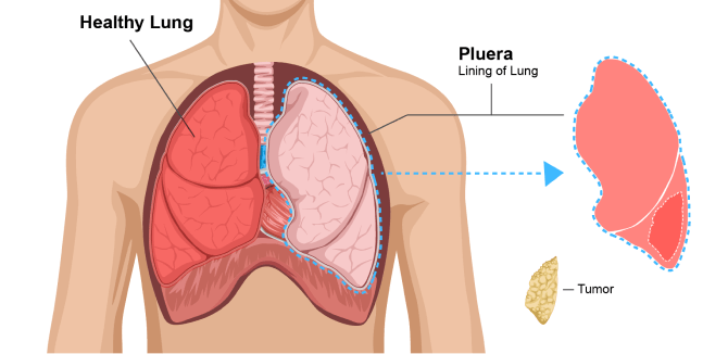 Diagram of a pleurectomy with decortication (P/D). The lung lining (pleura) and mesothelioma tumors are removed but the lung is spared.