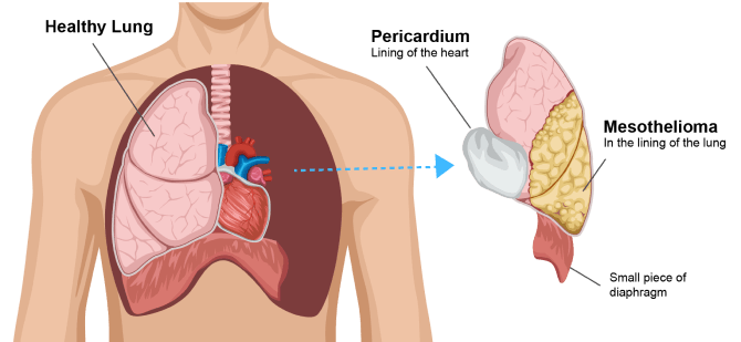 Diagram showing the steps of an extrapleural pneumonectomy. Doctors remove the healthy lung closest to the cancer, along with the pericardium (heart lining), a part of the diaphragm, and all visible cancer tumors.