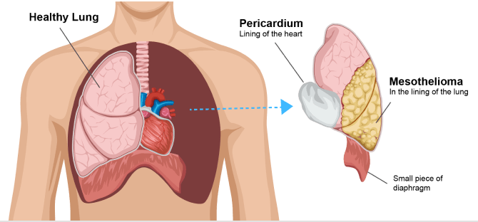 Extrapleural pneumonectomy (EPP)