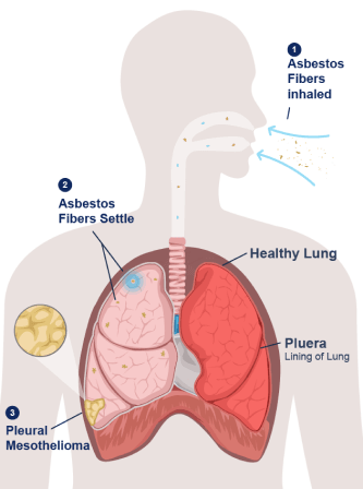 what is mesothelioma disease symptoms