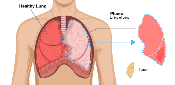 Diagram showing a pleurectomy with decortication. Doctors remove the lung lining and all visible cancer tumors.