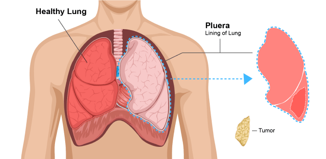 Diagram explaining a pleurectomy with decortication (P/D). Doctors remove the lung lining and cancer tumors. Neither lung is removed in this surgery. 