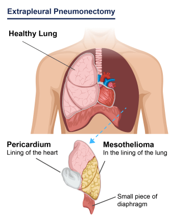 Diagram of an extrapleural pneumonectomy (EPP). The lung lining (pleura), heart lining (pericardium), diaphragm, lung, and mesothelioma tumors are removed with this surgery. 