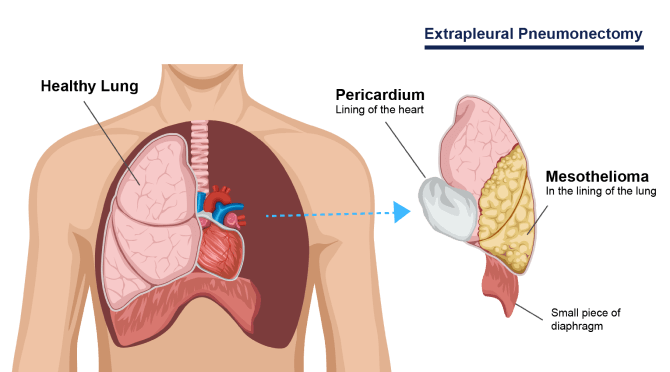 A diagram showing how an extrapleural pneumonectomy is performed. It shows a healthy lung (which is not removed) and organs that are removed (heart lining, lung, mesothelioma tumors, and a small piece of the diaphragm).