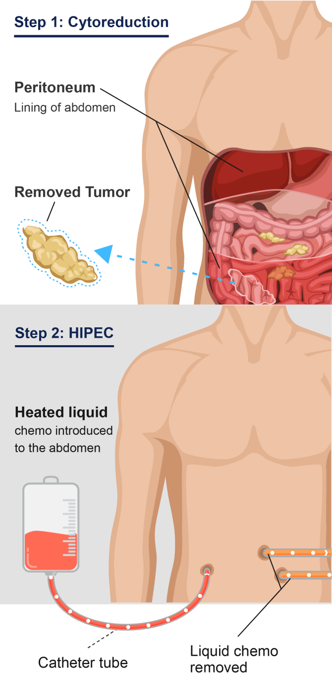 Graphic showing abdominal cytoreduction with HIPEC. Step 1 is cytoreductive surgery to remove cancer tumors from the abdomen. Step 2 is HIPEC (heated chemotherapy) inserted into the abdomen.