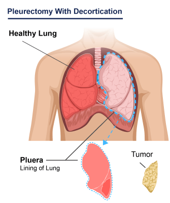 Diagram explaining a pleurectomy with decortication (P/D). Doctors remove the lung lining and cancer tumors. Neither lung is removed in this surgery.