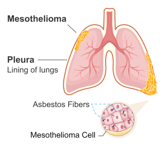 A diagram of pleural mesothelioma. Pleural mesothelioma tumors form in the lining of the lungs after asbestos fibers irritate healthy cells, causing them to mutate into cancerous ones.