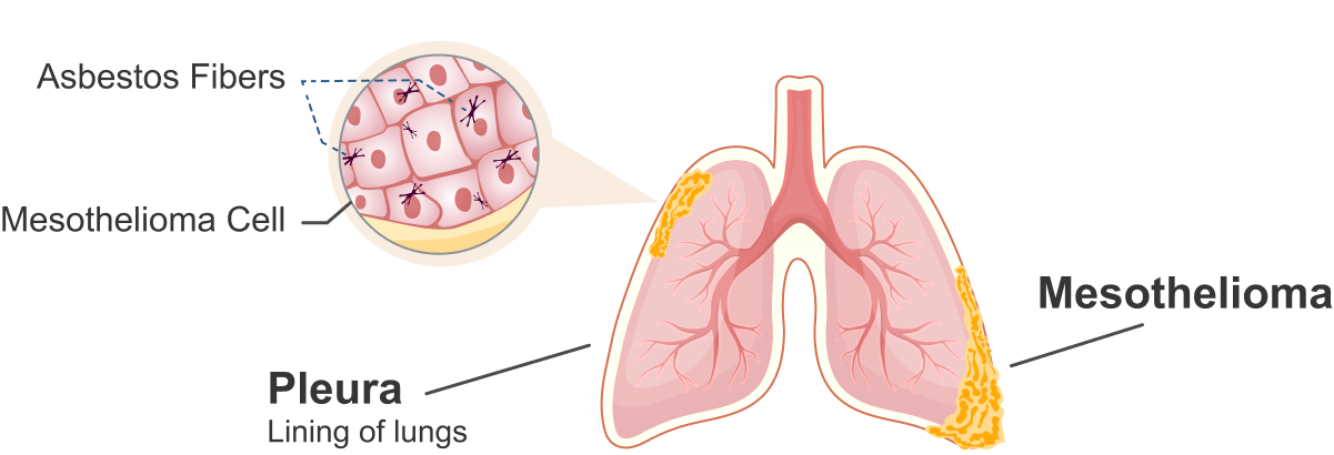 A diagram of pleural mesothelioma. Pleural mesothelioma tumors form in the lining of the lungs after asbestos fibers irritate healthy cells, causing them to mutate into cancerous ones.