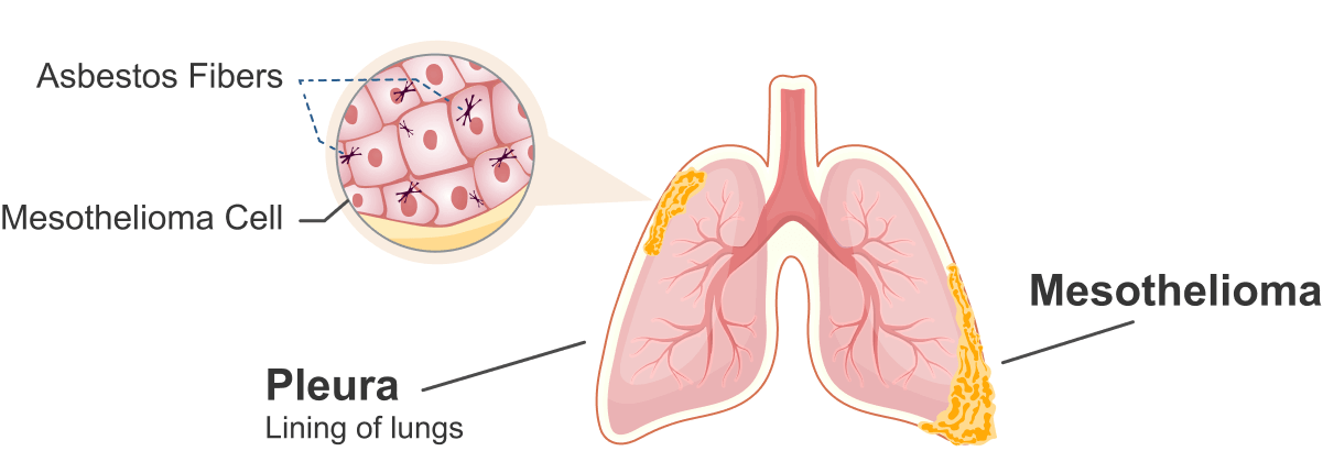 cystic peritoneal mesothelioma radiopaedia