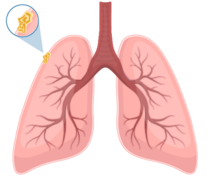 A drawing of the lungs with a zoomed-in view of mesothelioma tumors. Stage 1 pleural mesothelioma diagram.