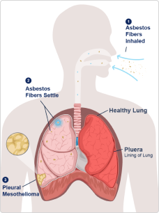 Pleural mesothelioma development diagram