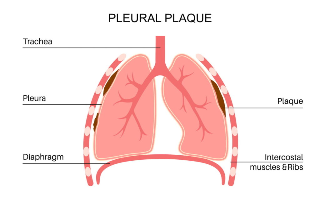 Graphic showing pleural plaque within the lung lining